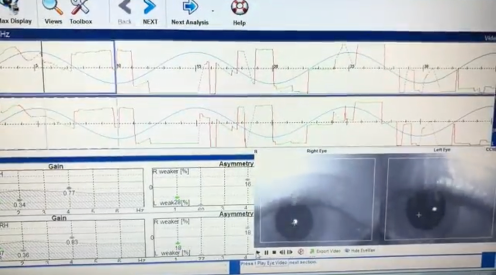 Video Nystagmography demonstrating impaired smooth pursuit eye movements before functional neurological rehabilitation.