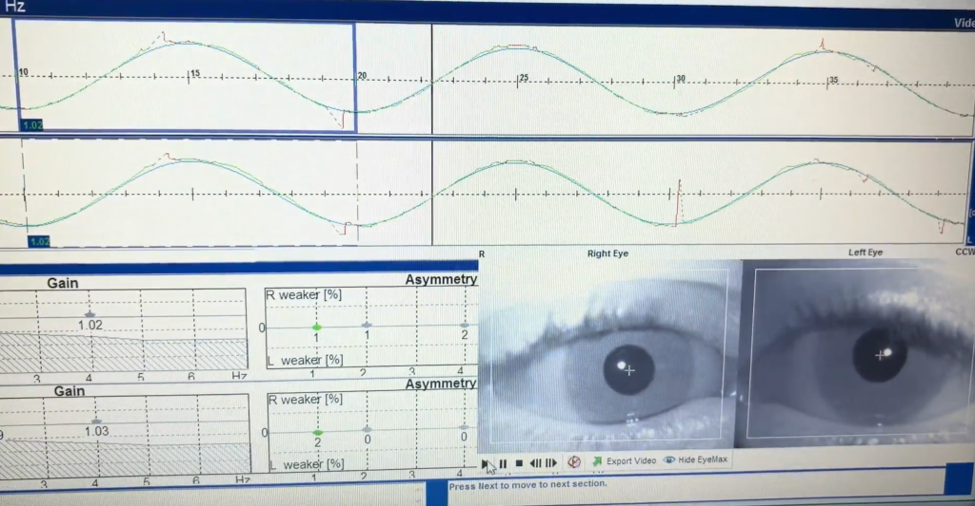 Repeat VNG showing significantly improved smooth pursuit eye movements following functional neurology treatment.